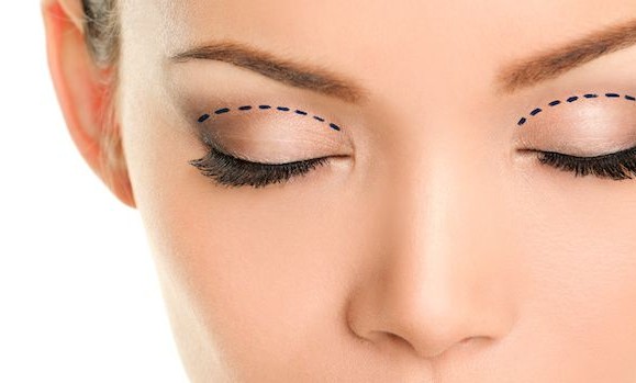 Blefaroplastica Milano - Dott. Alberto M. Zampori